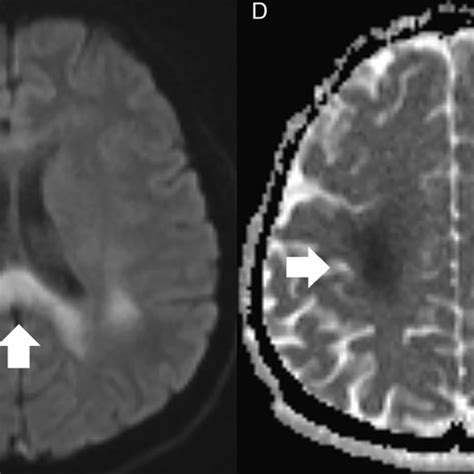 Brain Mri Axial A B And C Diffusion Weighted Images Dwi And D E