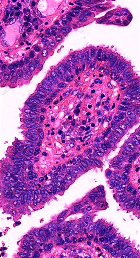 Pathology Of Syringocystadenoma Papilliferum Microscopic Photography