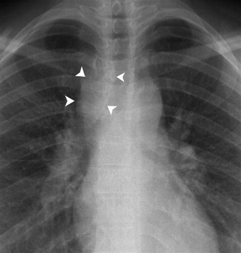 A Diagnostic Approach To Mediastinal Abnormalities Radiographics