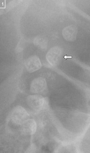 Gallstones Radiology Key