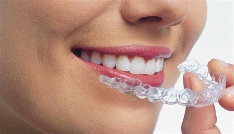 Invisalign La Ortodoncia Invisible Sonr A Cl Nica Dental