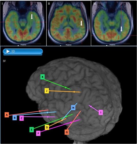 Stereo Eeg Exploration In A Case Of Eating Epilepsy With Cutlery