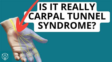 Carpal Tunnel Or Neck Radiculopathy How To Tell The Difference Aleks Physio Youtube