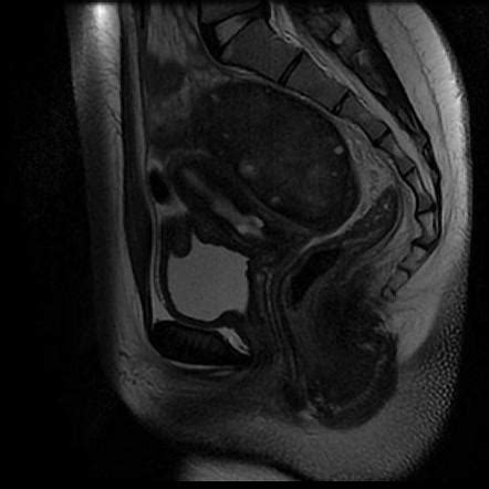 Ovarian Torsion Radiology Case Radiopaedia Org