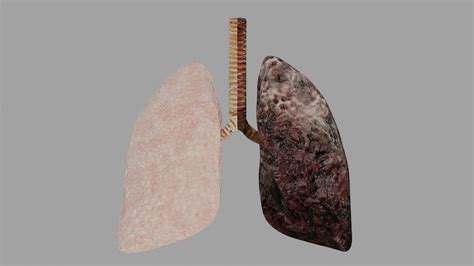 Smokers Lungs Vs Non Smokers Lungs