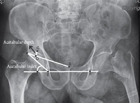 ­measurement­of­acetabular­morphology ­ab­ ­the­line­drawn