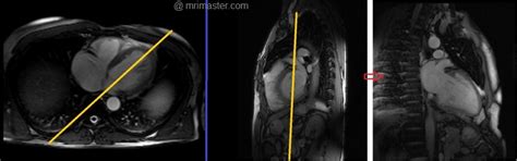 Cardiac Mri Protocols Planning And Techniques Positioning For