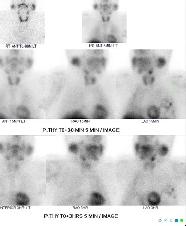 Tc 99m Sestamibi Radiology Reference Article Radiopaedia Org