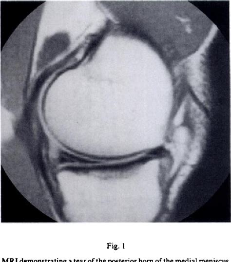 Figure From Magnetic Resonance Imaging Of Meniscal And Cruciate