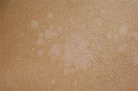 Pityriasis Versicolor Of The Skin Bild Kaufen Science