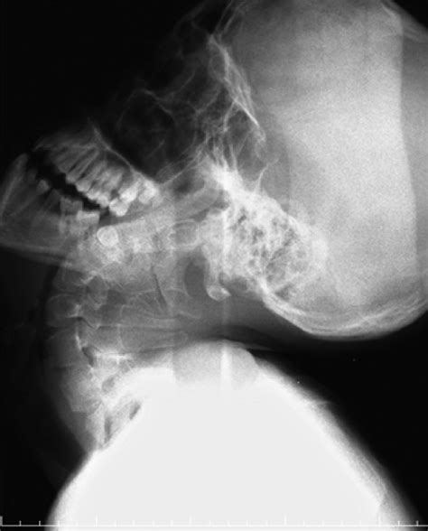 Lateral Cervical X Ray Radiograph Shows Cervical 59 Off