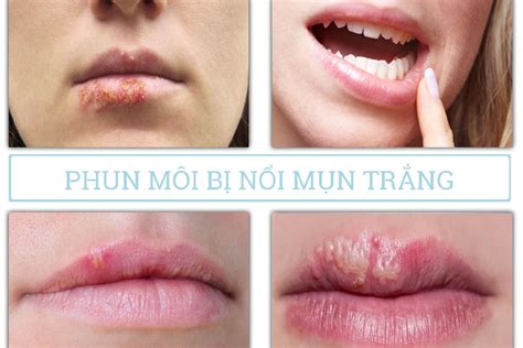 Sau phun môi bị nổi mụn trắng nổi hạt trắng phải làm sao