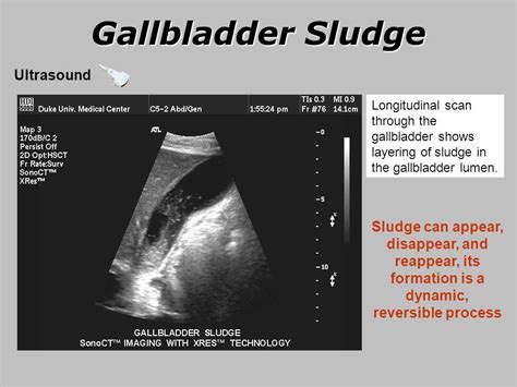 Gallbladder And Biliary Tract Disease Ppt Video Online Download