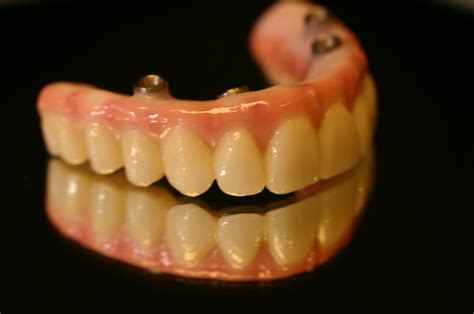 Implant Supported Dentures - Ueckert Dentistry