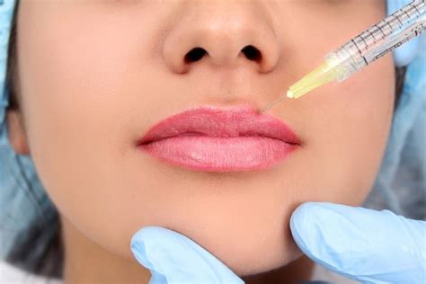 Clinica Que Faz Preenchimento Labial ácido Hialurônico Capão Redondo