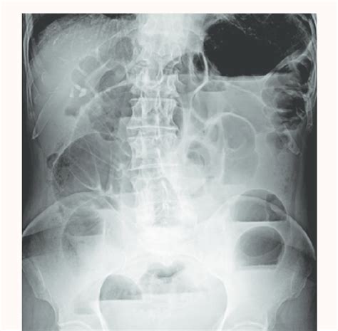 X Ray Showing Features Of Small Bowel Obstruction Download Scientific Diagram