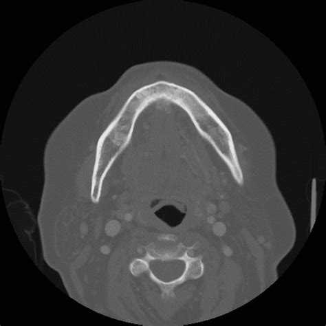 Mandibular Osteomyelitis Radiologypicscom