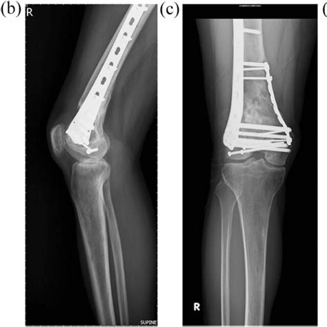 A A 59 Year Old Male With Closed Ao Type C3 Left Distal Femoral Download Scientific Diagram