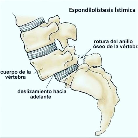 Qu Es La Espondilolistesis Cl Nica Mart N G Mez Traumat Logos