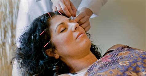 Acupuncture For Hair Loss Is It Effective