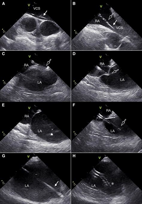 Ice Images Ah Taken During The Transseptal Puncture The Fr