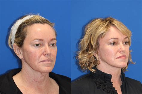 Patient 71703848 Fat Transfer Before And After Photos Carmel Valley Plastic Surgery