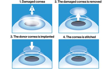 Corneal Transplant Or Keratoplasty How Is The Operation