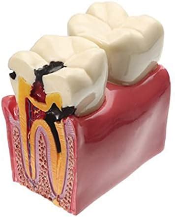 Dental Caries Tooth Model Dental Anatomy Education Tooth Model 6