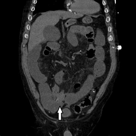 Ct Scan Coronal View Of The Abdomen Demonstrating Terminal Ileum