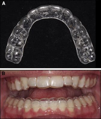 Do It Yourself Impressions And Clear Retainers A Fairy Tale Pocket