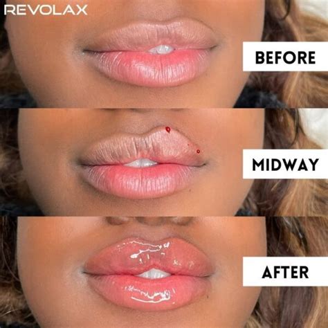 Lip Filler Before And After Photos And Results The Daily Glimmer