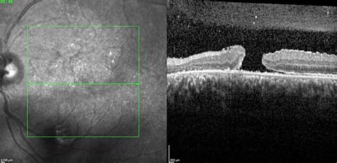 Le Trou Maculaire Post Traumatique Ophtalmo Paris