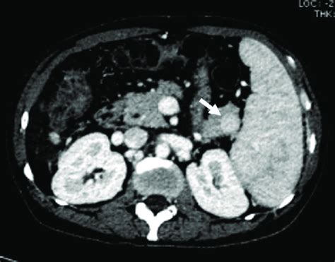 A 45 Year Old Male With Intrapancreatic Spleen Axial Contrast Enhanced