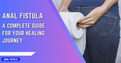 Understanding Anal Fistula A Complete Guide For Healing