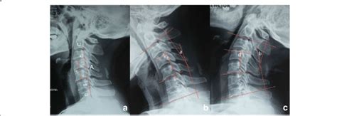 Normal Lateral Cervical Curve