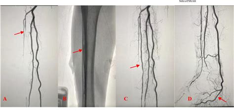 Pdf Chronic Limb Threatening Ischemia Successful Infra Popliteal Endovascular