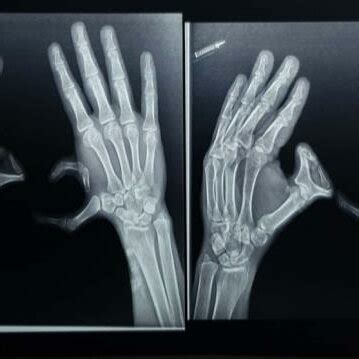 X Ray Pa View Of Both Hands D Echo Showed Normal Sized Lv With Severe