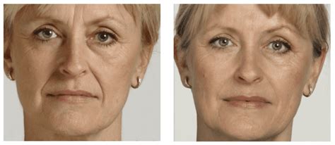 Frown Lines Treatment In Norwich | The Doctors Laser Clinic