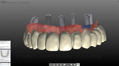 Protesi Digitale Su Impianti