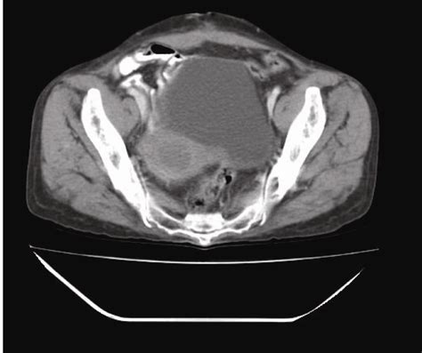 Post Operative Contrast Enhanced Computerized Tomography Showing