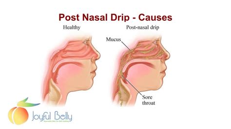 Nasal Backdrip How To Get Better Ent Specialist Singapore