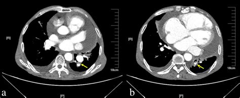 Emergency Thoracic Contrast Enhanced Computed Tomography Revealed