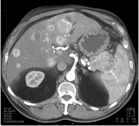 Pancreatic Neuroendocrine Tumor Pnet Tail Of The Pancreas With Liver