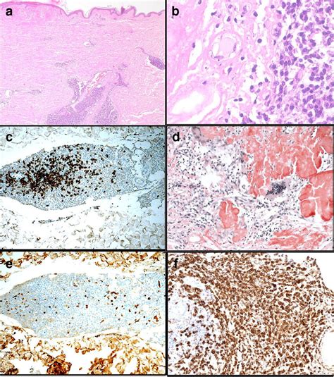 Primary Cutaneous Marginal Zone Lymphoma With Associated Amyloidosis Download Scientific