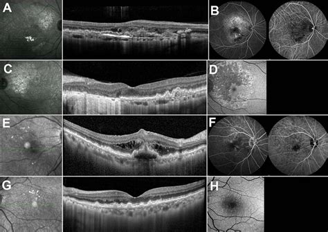 Representative Cases Of Type Mnv Eyes And Fellow Eyes With Multimodal