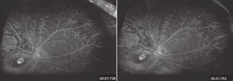 Ultra Widefield Fluorescein Angiograms Of A Pediatric Patient With Download Scientific Diagram