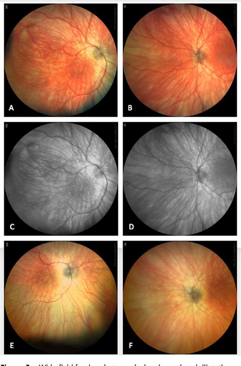 Figure 3 From Management Of Aggressive Posterior Retinopathy Of