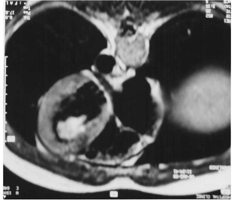 PDF Video Assisted Cardioscopy For Removal Of Primary Left