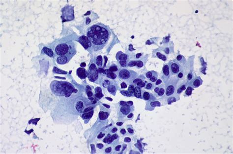 Non Small Cell Cancer Of The Lung MedicineBTG