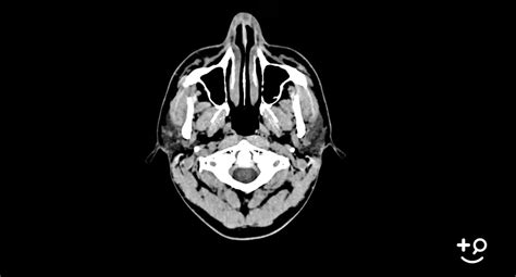 Glioblastoma Conclusion Doctorpedia Doctor Reviewed Video